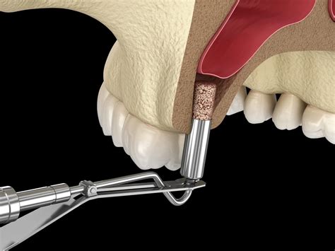 sinus lift port salerno fl|Sinus Lift Port Orange Ormond Beach & New Smyrna Beach FL, .